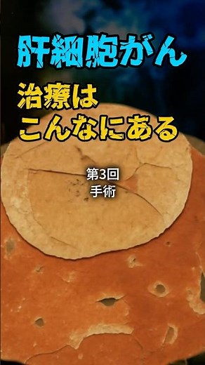 肝細胞がん、治療はこんなにある ③手術 #肝細胞癌 #肝臓がん #肝切除 #外科手術 #腹腔鏡手術 #ロボット手術 #がん治療 #医療解説 #shorts