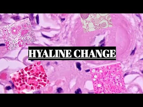 HYALINE CHANGE || FUNDAMENTALS WITH EXAMPLES ||