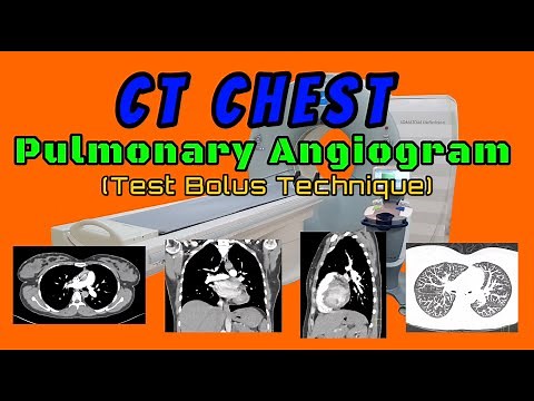 CT Chest Pulmonary Angiogram (Test Bolus Technique)