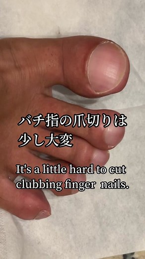 バチ指とその治し方について