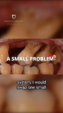 Advanced Periodontal Surgery London Gum Disease Treatment London Dental Specialists #shorts