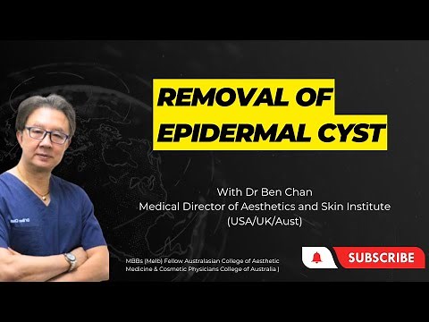 Epidermal cyst removal