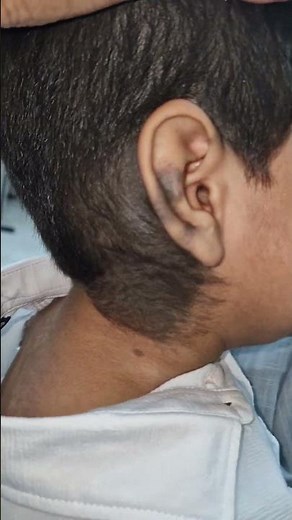 Giant Congenital Melanocytic Nevus (CMN) in a Child | Rare Birthmark |Dermatology