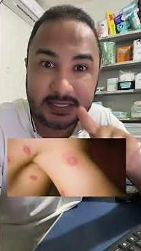 Clotrimazole for ringworm infection! #clotrimazole