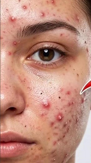How to remove pimples acne dark spots just in 7 days