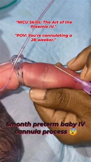 @nicu_nursing_work | "Precision and care in every step. Neonatal care requires the gentlest touch and expert skills. Watch the process of IV cannulation in a... | Instagram