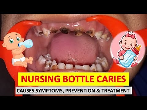 NURSING BOTTLE CARIES// CAUSES AND TREATMENT// BABY BOTTLE CARIES// ‪@dentalcafe4331‬