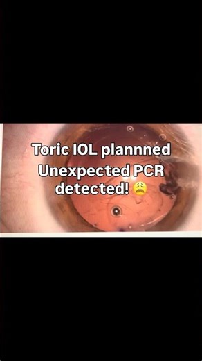 Toric IOL planned for cataract surgery then PCR - what to do?