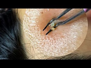 [ASMR] ALL-ZOOMED EXTRACTING Nose & Face whiteheads with tweezers | Clogged Pores