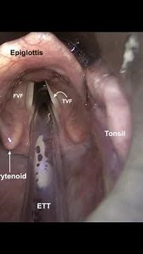 DIAGNOSTIC LARYNGOSCOPY; Procedure of diagnostic laryngoscopy, ent procedure