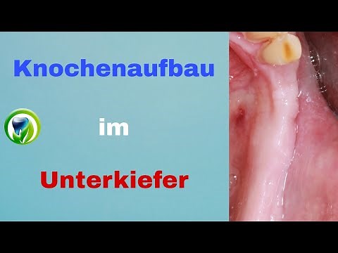 Knochenaufbau im Unterkiefer für Zahnimplantate - Knochenblock, Augmentation, Osteosyntheseschrauben