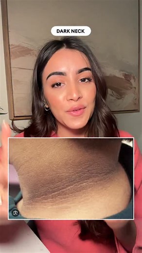 Dr. Riya Thorat on Instagram: "⚠️ If your neck looks like this (AN) — don’t ignore it. This can be a sign of underlying hormonal or metabolic imbalance, not just pigmentation. 💡 What you should do 👇 🧪 Get labs checked: Blood sugar, thyroid, ESR, CRP, LFT 🏃‍♀️ Focus on lifestyle changes — regular exercise + balanced diet 🧴 Exfoliate gently with lactic acid or glycolic acid (2–3×/week) ✨ Add kojic acid or arbutin to help reduce pigmentation over time 📌 Treat the cause and the skin — both mat