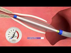 ACCLARENT AERA® Eustachian Tube Balloon Dilation System Animation
