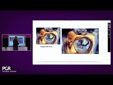 Advancing valve repair: mastering diverse mitral and TR anatomies with the PASCAL Precision system