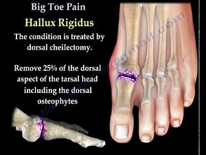 Big Toe Pain - Everything You Need To Know - Dr. Nabil Ebraheim