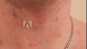 Close-up of chicken pox on the neck and chest of an adult male. Man is chickenpox, he problematic skin and scars from acne.