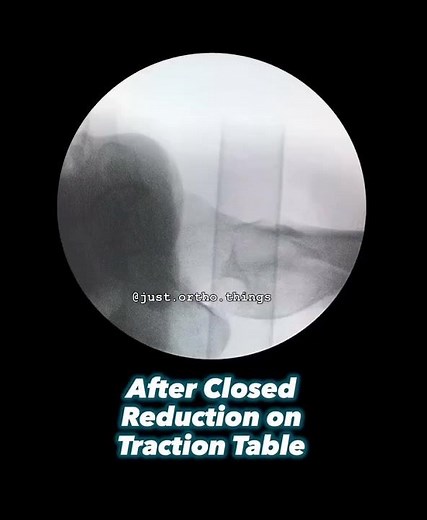 Comminuted Subtrochanteric Fracture