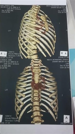 3Dimensional bony reconstitution