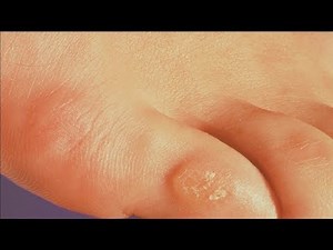 how to get rid of corns on toes fast
