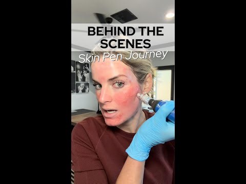 My Real SkinPen Journey: Prep, Procedure, and Recovery (No Filter!)