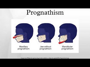 Prognathism