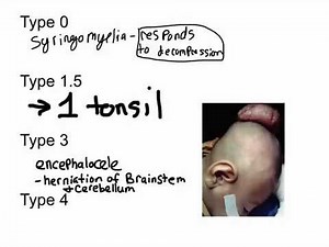 Chiari Malformation (Types 1-4)