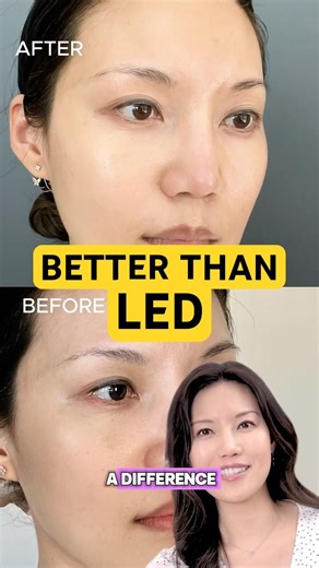2 Months With This Laser & My Skin Changed #antiagingskincare