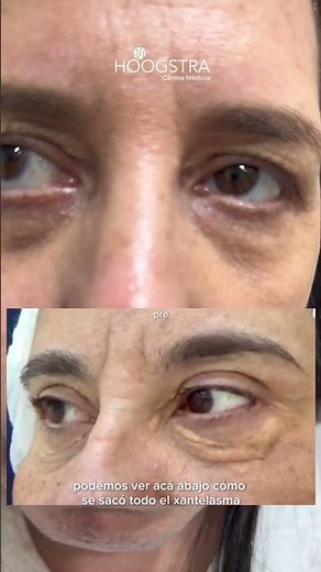 Xanthelasma - Laser treatment
