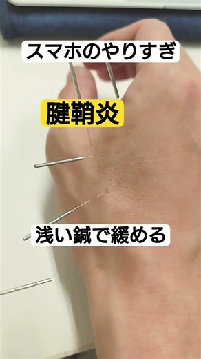 スマホ腱鞘炎