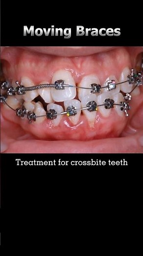 Amazing braces: Fix crossbite teeth process #braces #orthodontist #dentist #teeth #asmr