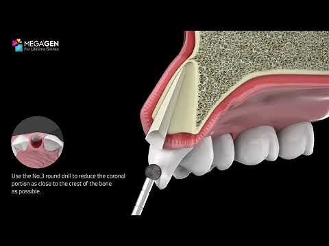 MegaGen PET Kit - Socket Shield Procedure