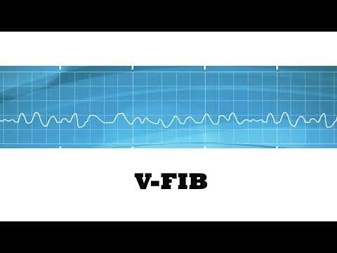 If EKG Rhythms were songs