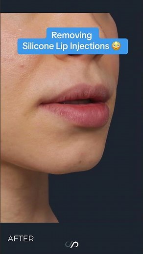 The Dark Side of Silicone Lip Injections: A Warning