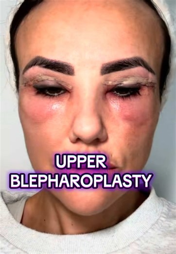 Upper Eyelid Surgery Healing Journey: Before and After