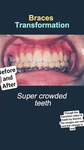 Orthodontic Treatment Before and After #orthodontist #dental