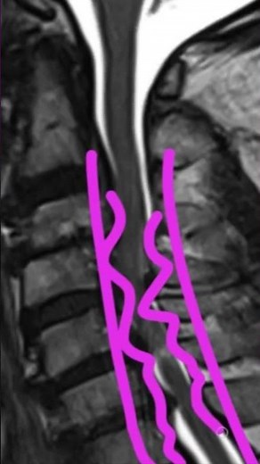 Understanding Arthritis in the Spine: Causes, Symptoms & Treatment Options with Dr. Jeffrey Cantor