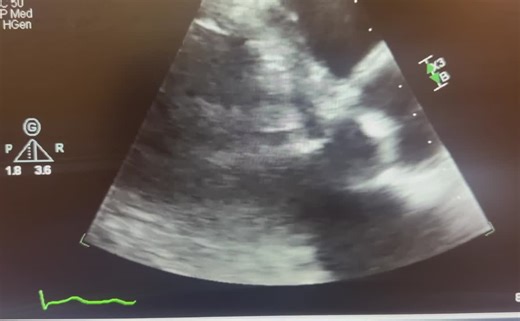 #echocardiography #cardiology #hocm #hypertrophiccardiomyopathy #cardiacimaging #echolife #sonographer #tte #lvot #mitralregurgitation #structuralheart | Jaynel Dunlap BA, RDCS, RCS, FASE