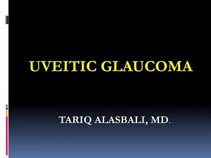 PPT - UVEITIC GLAUCOMA PowerPoint Presentation, free download - ID:6765745