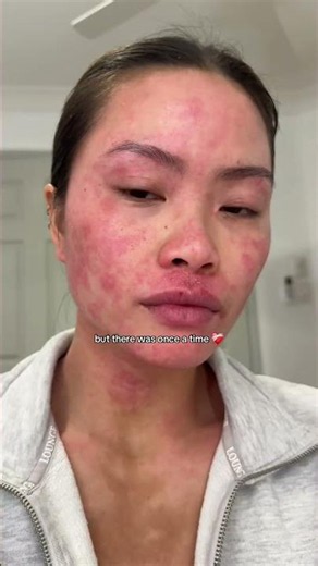 The difference from when my eczema & face dermatitis was at its worst to now 🥹🤍 #dupixent #eczema