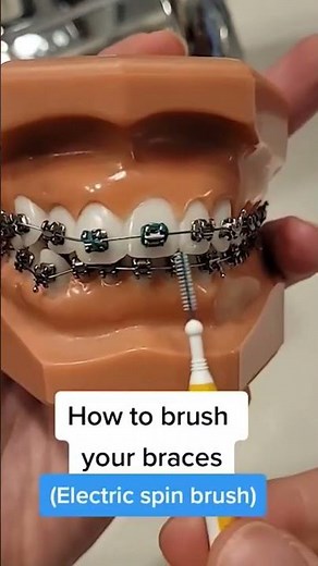 Brushing with braces + proxabrushes