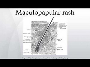 Maculopapular rash