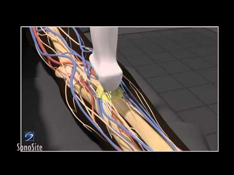 How To: Ultrasound Guided Abscess Drainage 3D Video