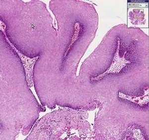 Histopathology Vulva --Condyloma accuminata (viral induced s