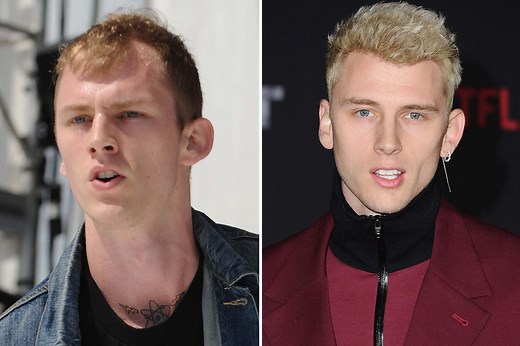 Did Machine Gun Kelly get a hair transplant?