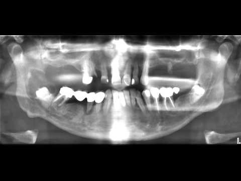 wie kommt es zu Zahnzysten - Kieferzysten?