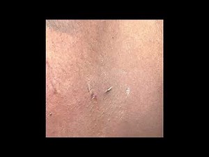 Steatocystoma Have Become Ine Of My Favorites 🙃