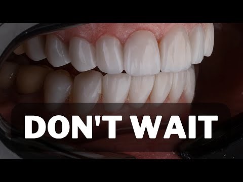 JS Dental Lab Night Guard Review