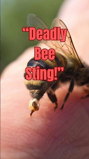 Bee Allergy Explained: When a Sting Becomes Deadly! 🐝🚨