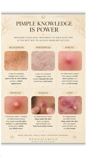 Acne Types Explained ✨ Blackheads, Pustules, Nodules & Cysts