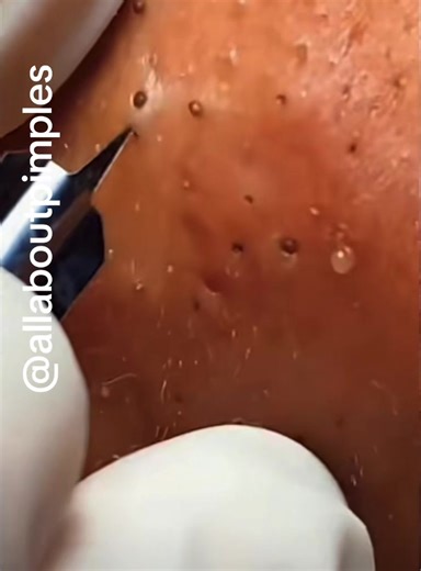 Acne on the chin #pimplepopping #fyp #satifyingvideo #pimpleremover #pimpleextraction